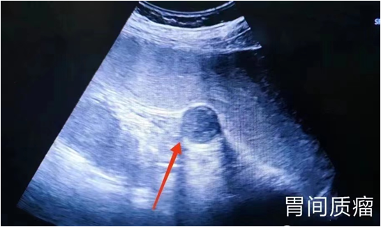 胃造影用的是什么机子胃肠检查的新技术、新突破——胃肠充盈超声造影_https://www.jmylbn.com_新闻资讯_第9张