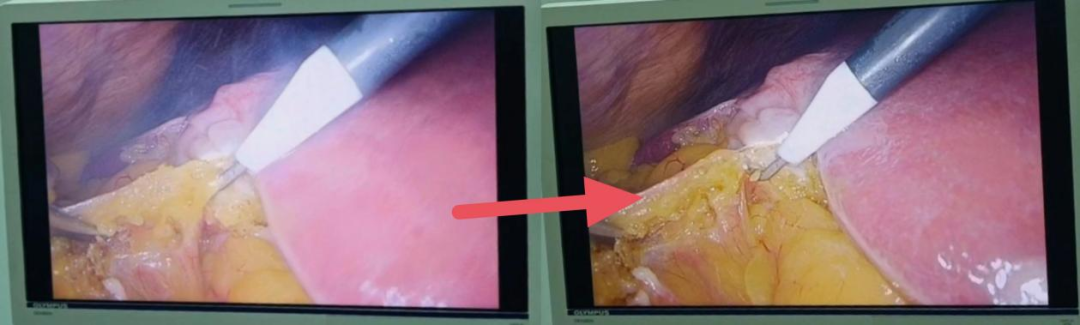 手术吸引器怎么使用手术室护士自制腹腔镜手术烟雾排除装置，烟雾退退退~_https://www.jmylbn.com_新闻资讯_第5张