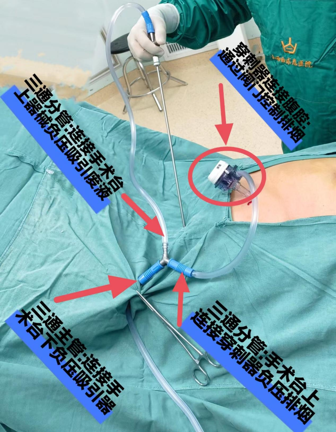 手术吸引器怎么使用手术室护士自制腹腔镜手术烟雾排除装置，烟雾退退退~_https://www.jmylbn.com_新闻资讯_第3张