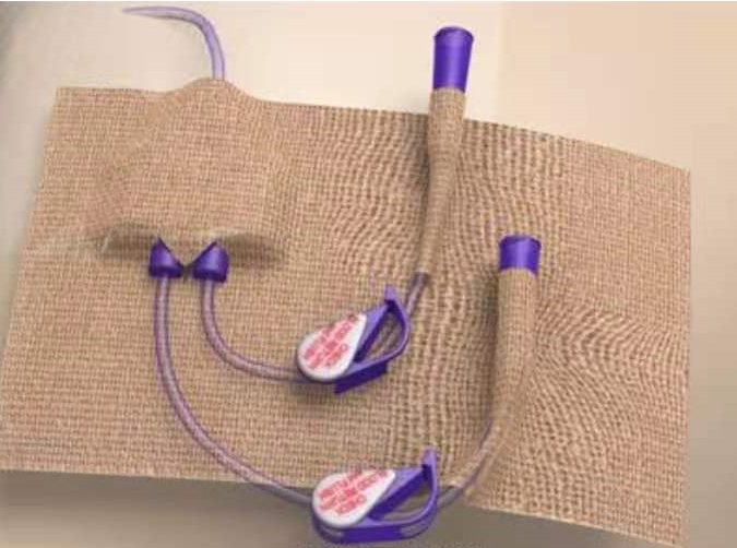 双腔cvc怎么开关护理技巧 ｜ 双腔导管的正确冲封管_https://www.jmylbn.com_新闻资讯_第3张