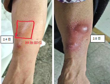 一例静脉留置针拔除后，前臂肿胀引发的思考