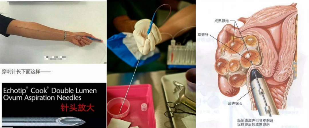 取卵针长什么样看过女性取卵的35cm穿刺针，我才明白为什么要抵制代孕！_https://www.jmylbn.com_新闻资讯_第5张
