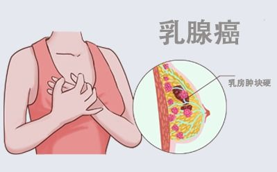 乳腺癌-可愈有道