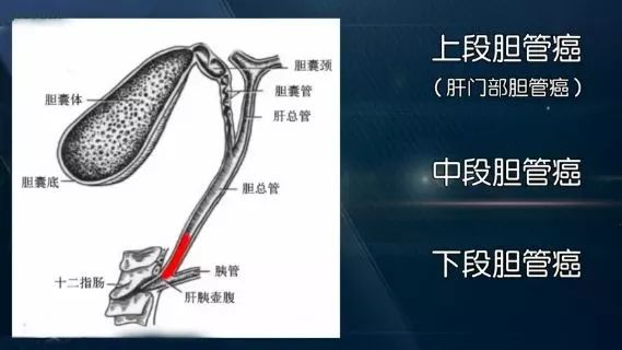 胆管癌-可愈有道