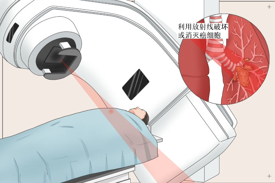放射治疗-可愈有道