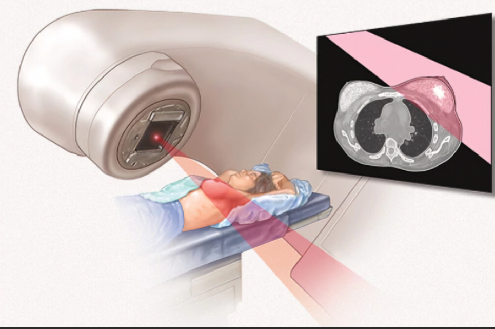 放射治疗-可愈有道