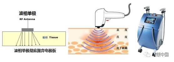 多极射频是什么【科普】射频RF应用于医美抗衰发展历程_https://www.jmylbn.com_新闻资讯_第12张