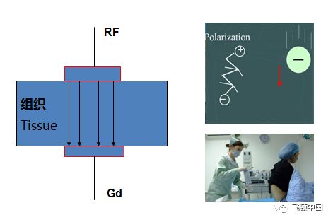 多极射频是什么【科普】射频RF应用于医美抗衰发展历程_https://www.jmylbn.com_新闻资讯_第10张