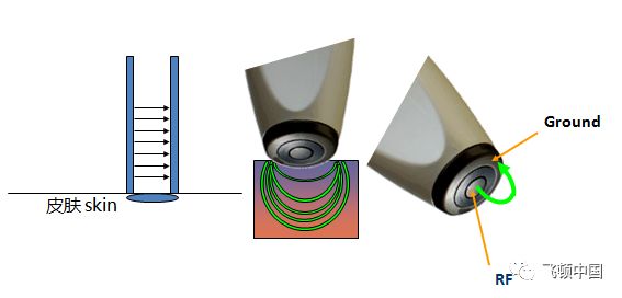 多极射频是什么【科普】射频RF应用于医美抗衰发展历程_https://www.jmylbn.com_新闻资讯_第11张