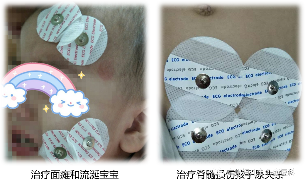 中频为什么能镇痛【康复小知识】中频电疗法_https://www.jmylbn.com_新闻资讯_第2张