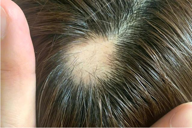 导致斑秃的原因是什么？斑秃能治好吗？