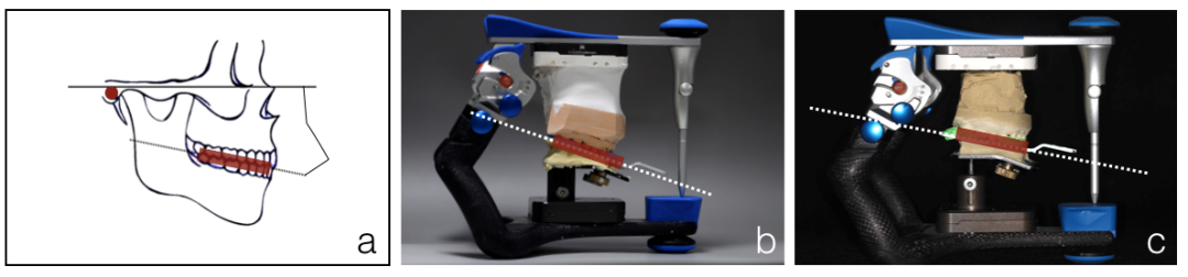 半可调颌架有哪些HE架模拟下颌运动的原理及常见分类_https://www.jmylbn.com_新闻资讯_第6张