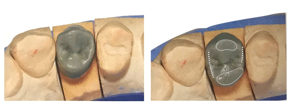 半可调颌架有哪些HE架模拟下颌运动的原理及常见分类_https://www.jmylbn.com_新闻资讯_第18张