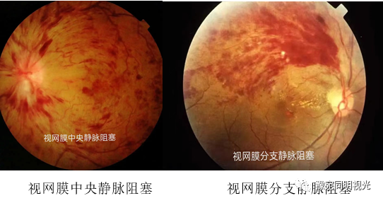 眼底激光机有什么牌子【高端设备】豫宛同明眼科医院引进瑞士美瑞激光治疗仪，进入眼底诊疗新时代_https://www.jmylbn.com_新闻资讯_第15张