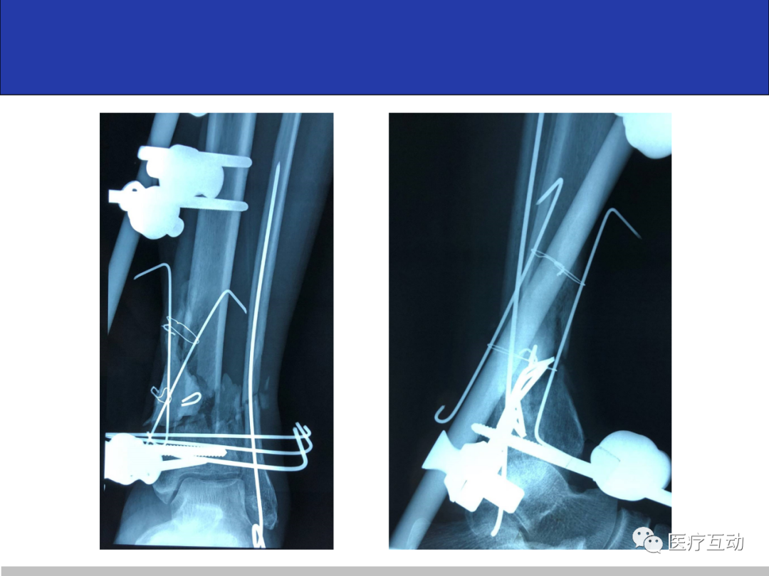 髋关节股骨固定支具股骨骨折护具可调髋骨外展支架胯部术后护具-阿里巴巴