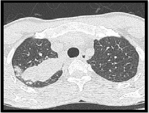 abp在医学是什么意思如何区分4种类型的肺曲霉菌病影像学表现？_https://www.jmylbn.com_新闻资讯_第13张