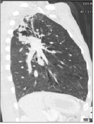 abp在医学是什么意思如何区分4种类型的肺曲霉菌病影像学表现？_https://www.jmylbn.com_新闻资讯_第6张