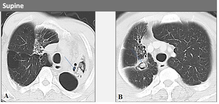 abp在医学是什么意思如何区分4种类型的肺曲霉菌病影像学表现？_https://www.jmylbn.com_新闻资讯_第2张