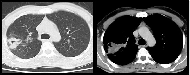 abp在医学是什么意思如何区分4种类型的肺曲霉菌病影像学表现？_https://www.jmylbn.com_新闻资讯_第14张