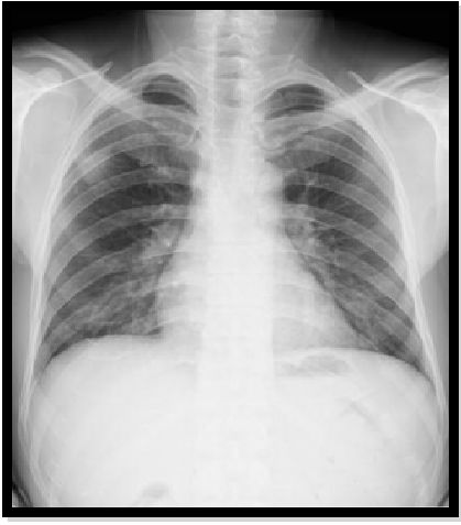 abp在医学是什么意思如何区分4种类型的肺曲霉菌病影像学表现？_https://www.jmylbn.com_新闻资讯_第12张