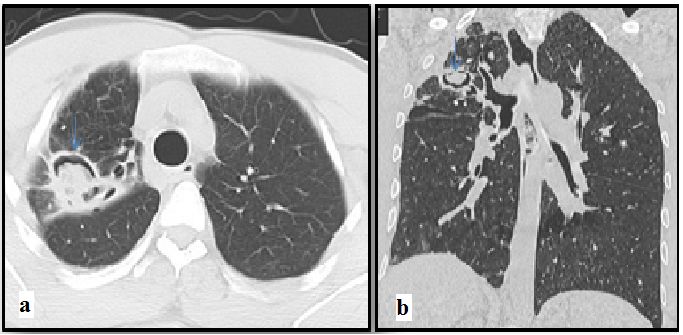 abp在医学是什么意思如何区分4种类型的肺曲霉菌病影像学表现？_https://www.jmylbn.com_新闻资讯_第8张