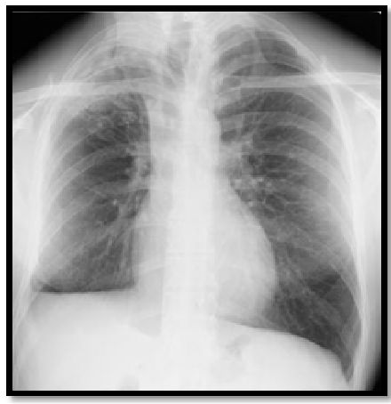 abp在医学是什么意思如何区分4种类型的肺曲霉菌病影像学表现？_https://www.jmylbn.com_新闻资讯_第7张