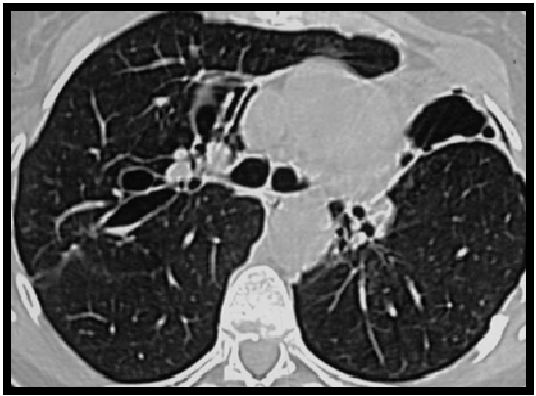 abp在医学是什么意思如何区分4种类型的肺曲霉菌病影像学表现？_https://www.jmylbn.com_新闻资讯_第11张