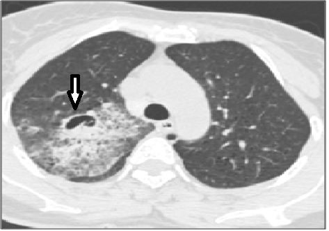 abp在医学是什么意思如何区分4种类型的肺曲霉菌病影像学表现？_https://www.jmylbn.com_新闻资讯_第4张