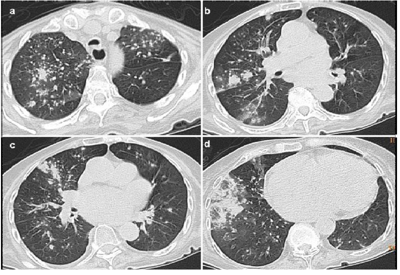 abp在医学是什么意思如何区分4种类型的肺曲霉菌病影像学表现？_https://www.jmylbn.com_新闻资讯_第16张