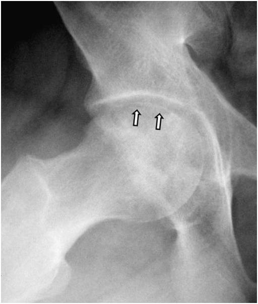 影像总结股骨头缺血坏死的病理基础及影像学表现