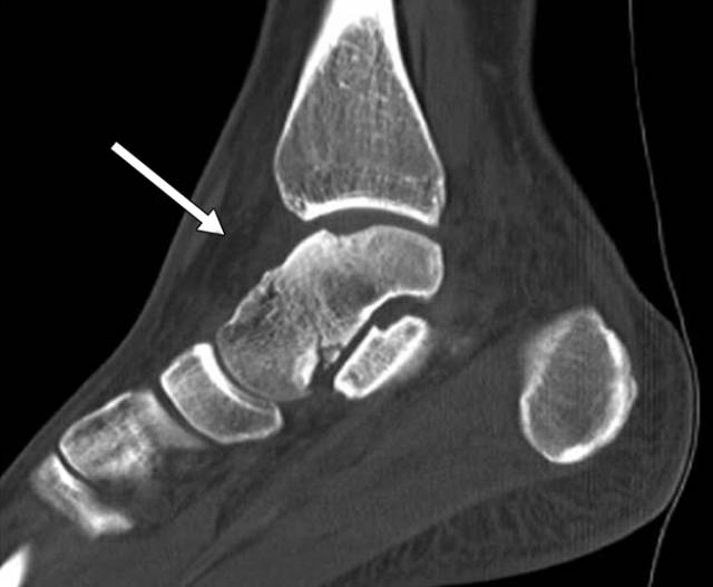 怎么取放射片研究--浅析下肢创伤中容易漏诊的X线片_https://www.jmylbn.com_新闻资讯_第15张