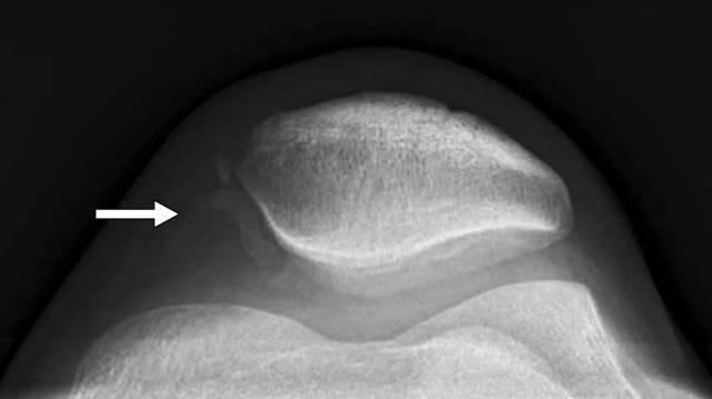 怎么取放射片研究--浅析下肢创伤中容易漏诊的X线片_https://www.jmylbn.com_新闻资讯_第3张