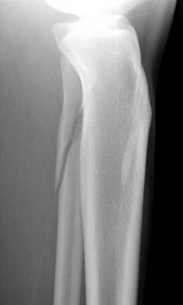 怎么取放射片研究--浅析下肢创伤中容易漏诊的X线片_https://www.jmylbn.com_新闻资讯_第11张