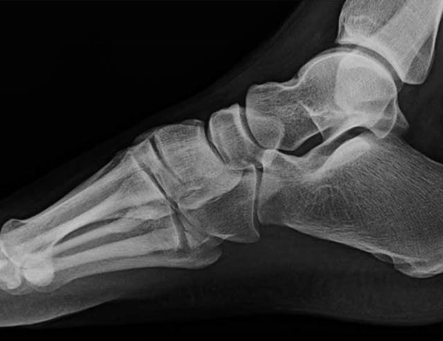 怎么取放射片研究--浅析下肢创伤中容易漏诊的X线片_https://www.jmylbn.com_新闻资讯_第17张