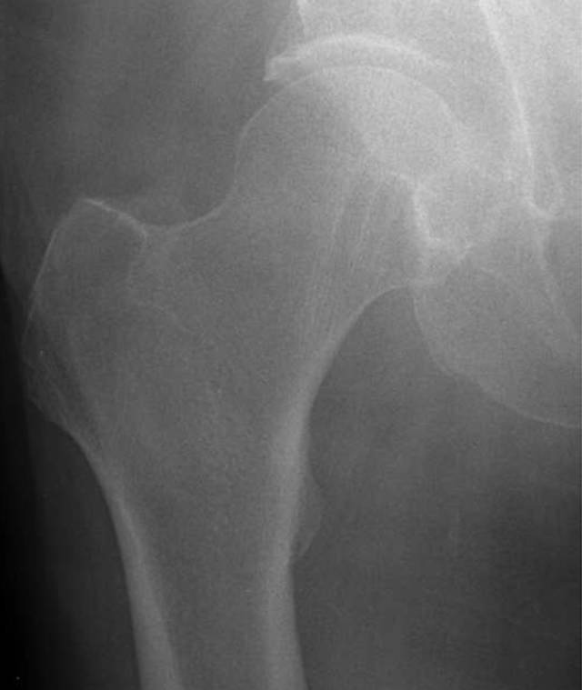 怎么取放射片研究--浅析下肢创伤中容易漏诊的X线片_https://www.jmylbn.com_新闻资讯_第7张