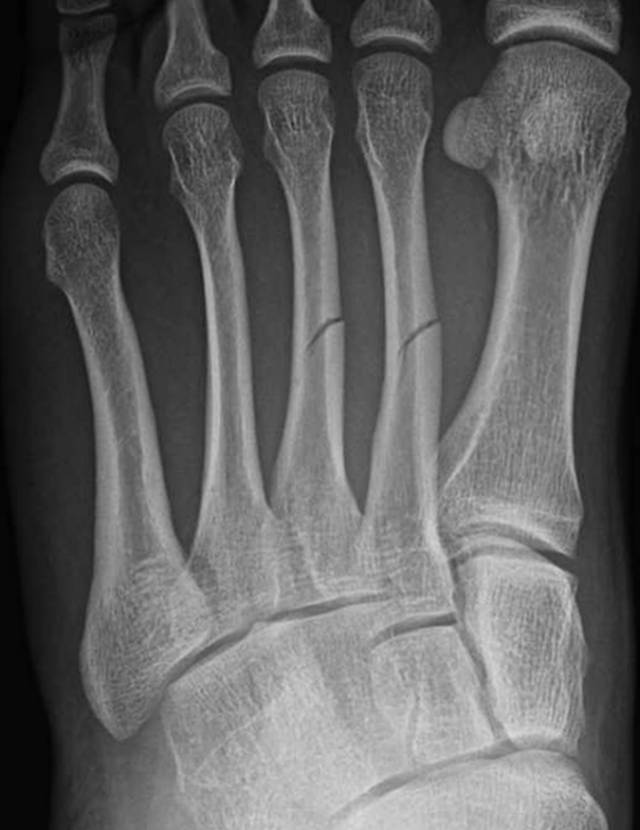 怎么取放射片研究--浅析下肢创伤中容易漏诊的X线片_https://www.jmylbn.com_新闻资讯_第4张