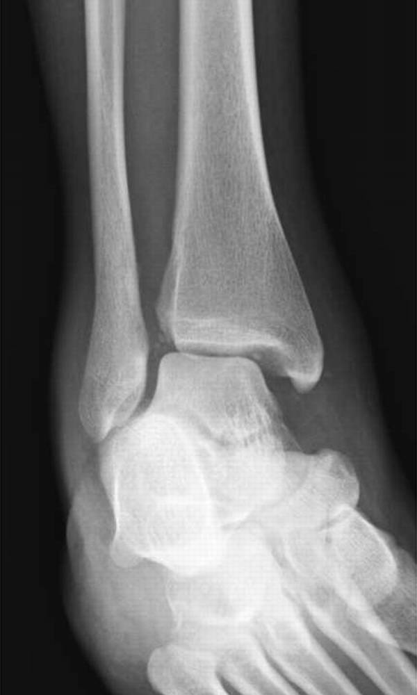 怎么取放射片研究--浅析下肢创伤中容易漏诊的X线片_https://www.jmylbn.com_新闻资讯_第10张