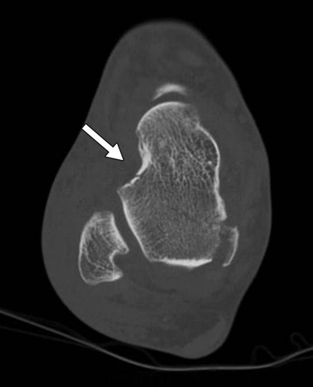 怎么取放射片研究--浅析下肢创伤中容易漏诊的X线片_https://www.jmylbn.com_新闻资讯_第16张