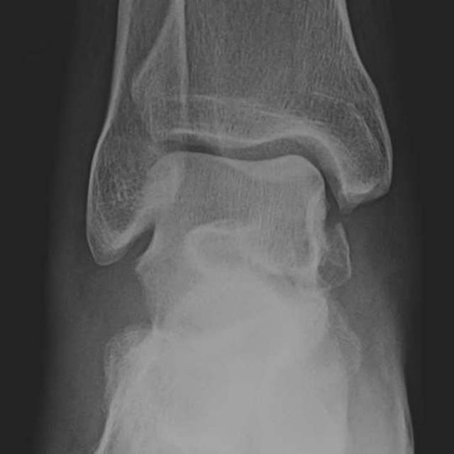 怎么取放射片研究--浅析下肢创伤中容易漏诊的X线片_https://www.jmylbn.com_新闻资讯_第13张