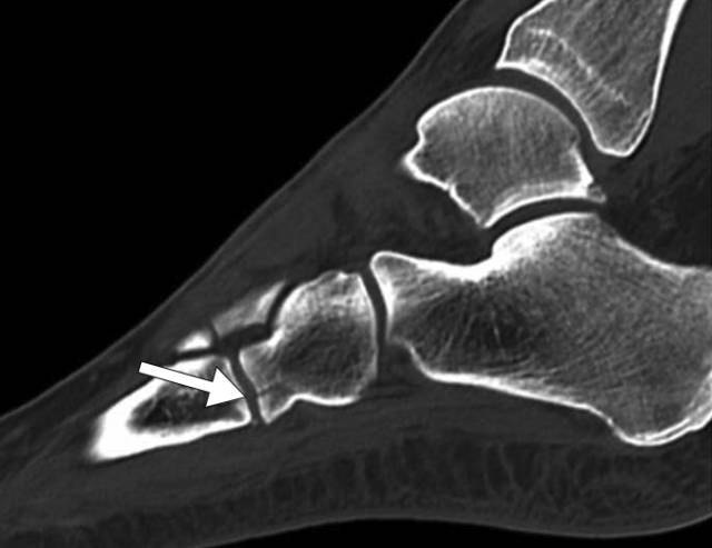 怎么取放射片研究--浅析下肢创伤中容易漏诊的X线片_https://www.jmylbn.com_新闻资讯_第18张
