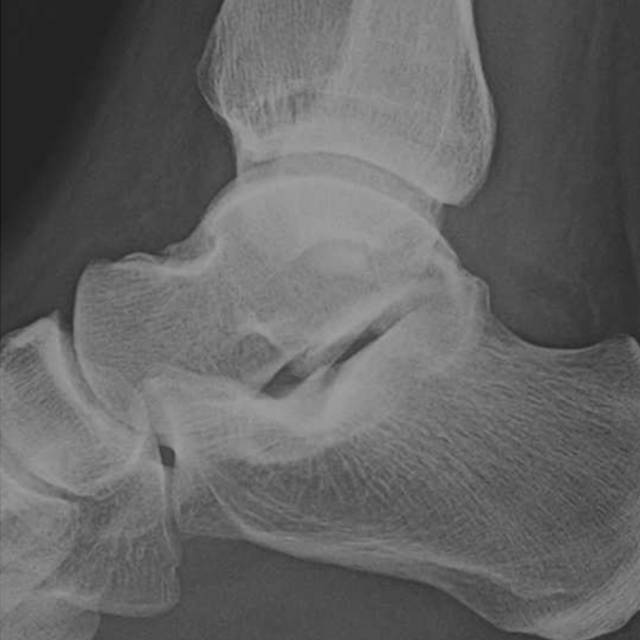 怎么取放射片研究--浅析下肢创伤中容易漏诊的X线片_https://www.jmylbn.com_新闻资讯_第14张