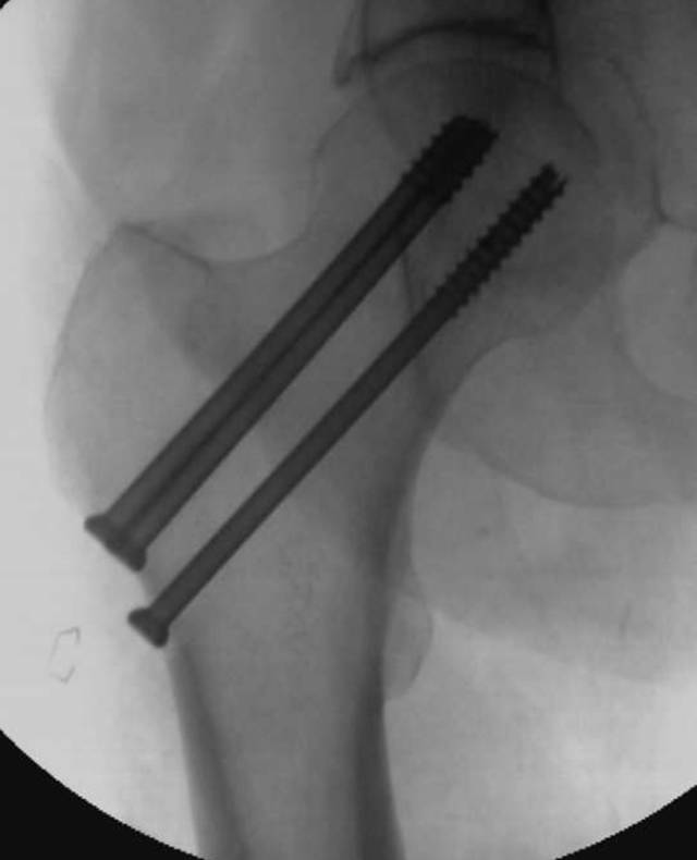 怎么取放射片研究--浅析下肢创伤中容易漏诊的X线片_https://www.jmylbn.com_新闻资讯_第9张