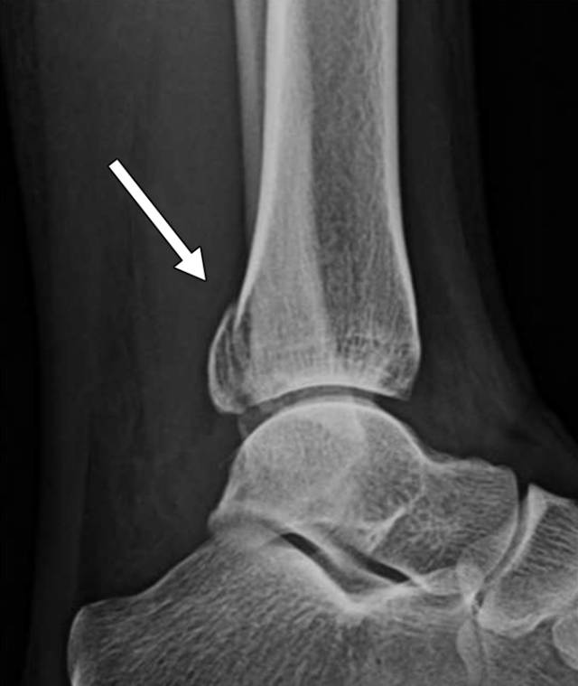 怎么取放射片研究--浅析下肢创伤中容易漏诊的X线片_https://www.jmylbn.com_新闻资讯_第19张