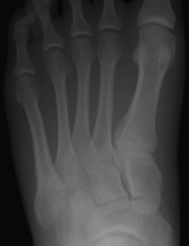 怎么取放射片研究--浅析下肢创伤中容易漏诊的X线片_https://www.jmylbn.com_新闻资讯_第5张