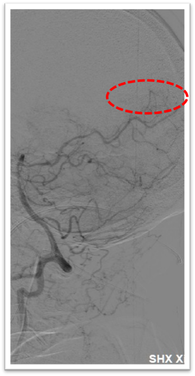 动脉长鞘怎么置入一鱼多吃，长鞘巧用抽吸术 ｜ 颈总动脉大负荷血栓取栓一例_https://www.jmylbn.com_新闻资讯_第12张
