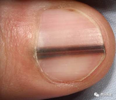 发现指甲有黑线一定立刻去医院，这是致死率极高的黑色素瘤！ - 7