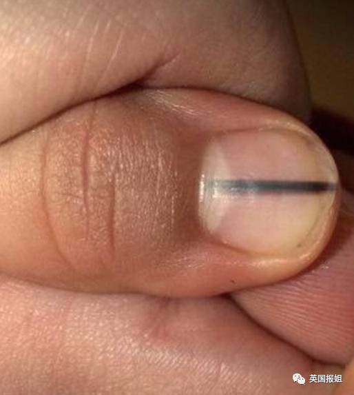 发现指甲有黑线一定立刻去医院，这是致死率极高的黑色素瘤！ - 2