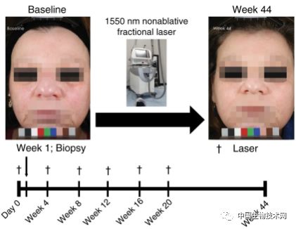 激光嫩肤、祛斑除皱...科学家阐明其背后的工作原理
