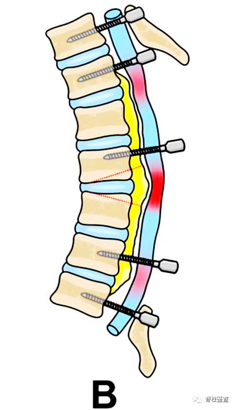 of the posterior longitudinal ligament in the thoracic spine,t