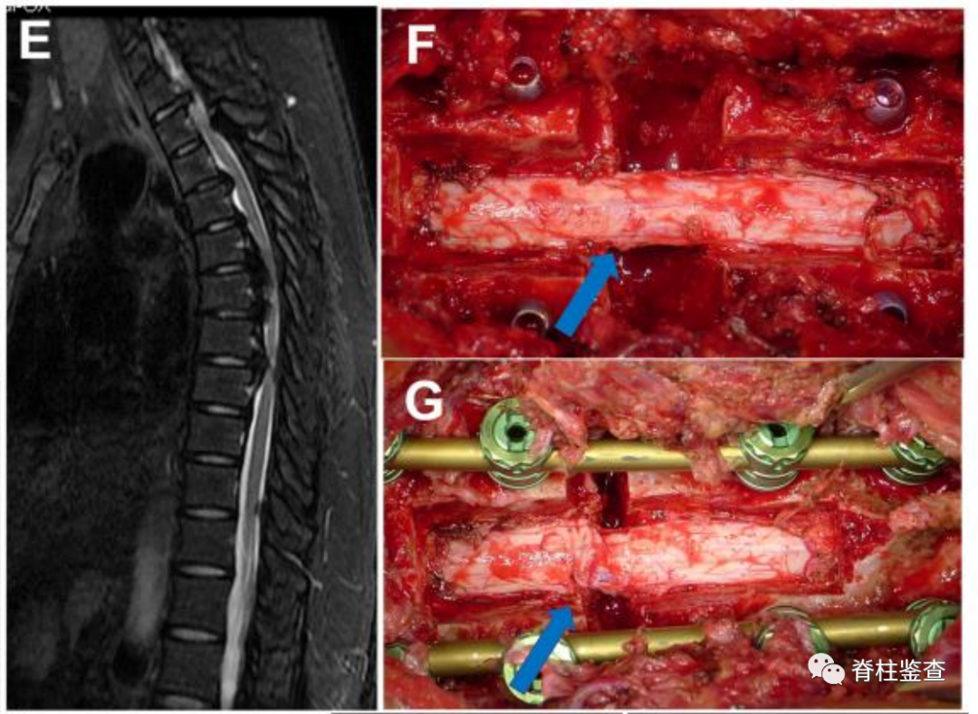 早讀| 治療多節段胸椎後縱韌帶骨化的一種新術式:至少隨訪3年的前瞻性